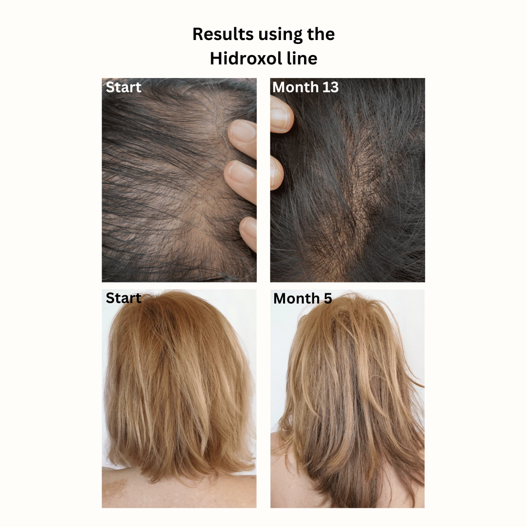 Before and after results using Hidroxol Hair Growth Tonic, visible improvement in hair density and scalp coverage. 